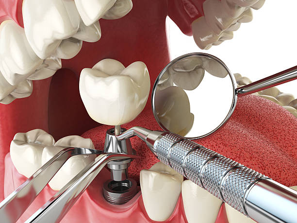 Best Chipped Tooth Repair Near Me  in Vernon, AL